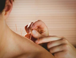 ACUPUNCTURE